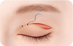 05. STEP surgery illustration
