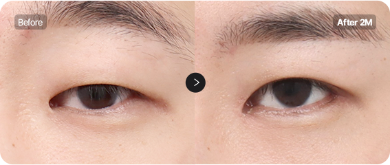 Before and After