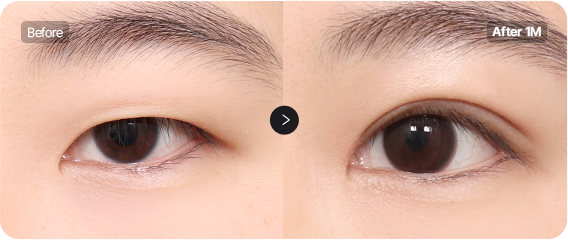 Before and After
