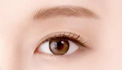 Case the Ptosis Correction is done well surgery illustration