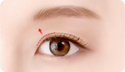 In case of inward overcorrection surgery illustration