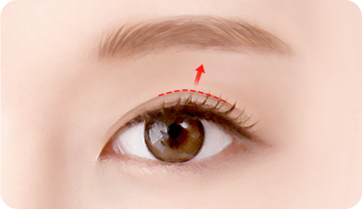 Outward overcorrection (commonly occurs) surgery illustration