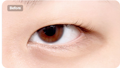 When double eyelids lowered surgery illustration