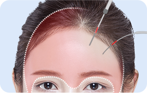 02. STEP surgery illustration