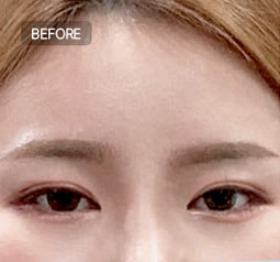 Before and After