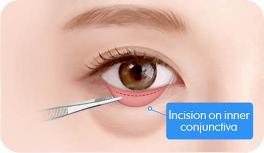 Step 2. Conjunctival incision surgery illustration