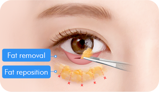Step 3. Under-eye fat removal and repositioning surgery illustration