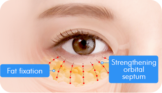Step 4. Orbital septum restoration surgery illustration