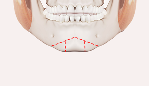 Step 1: Customized Design surgery illustration