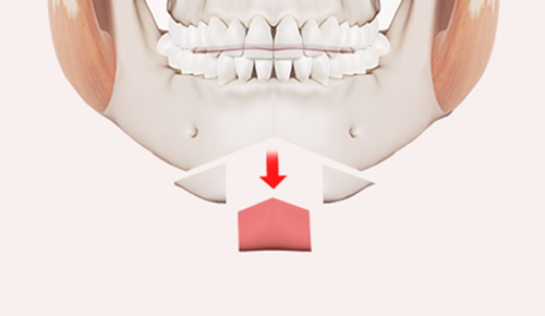 Step 2: Bone Resection  surgery illustration