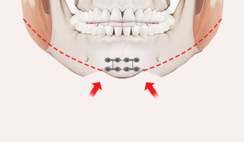 Step 3: Bone Repositioning  surgery illustration