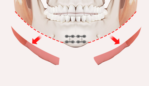 Step 4: Fixation and Contouring  surgery illustration