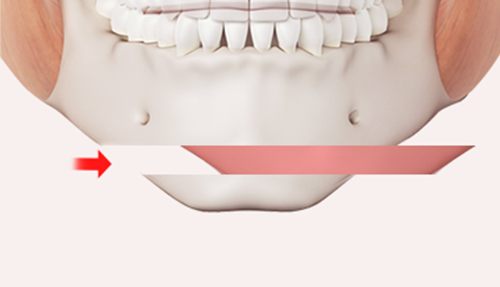 Step 1: Bone Resection surgery illustration