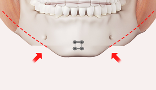 Step 2: Bone Shifting surgery illustration