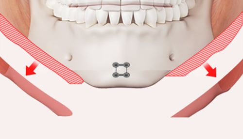 Step 3. Fixation and contouring surgery illustration