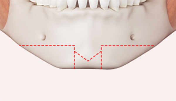 Step 1: Customized Design surgery illustration