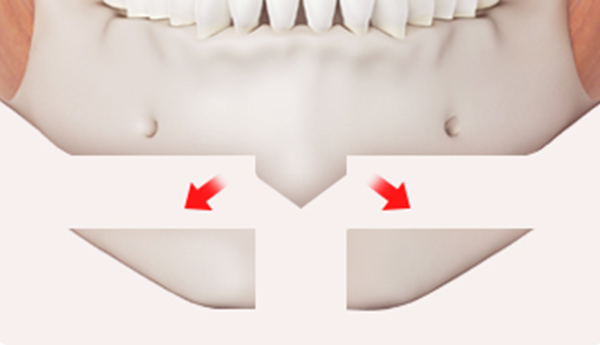 Step 2: Osteotomy and Bone Repositioning surgery illustration
