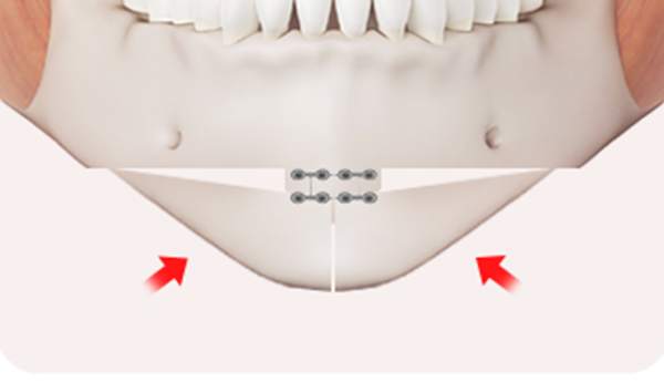 Step 3: Bone Fixation surgery illustration