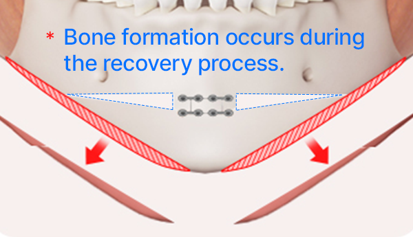 Step 4: Contouring the Jawline surgery illustration