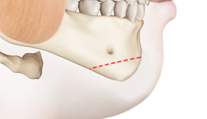 Step 1: Osteotomy surgery illustration