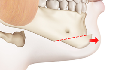 Step 2: Bone Advancement and Fixation surgery illustration