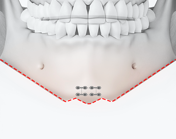 Chin tip reduction only surgery illustration