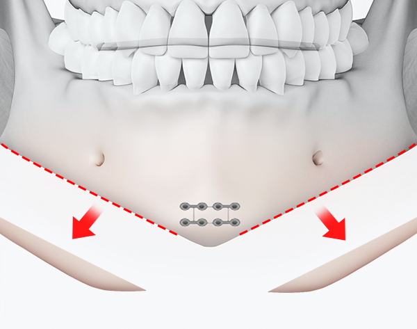 Chin tip reduction + Square jaw reduction combined surgery illustration