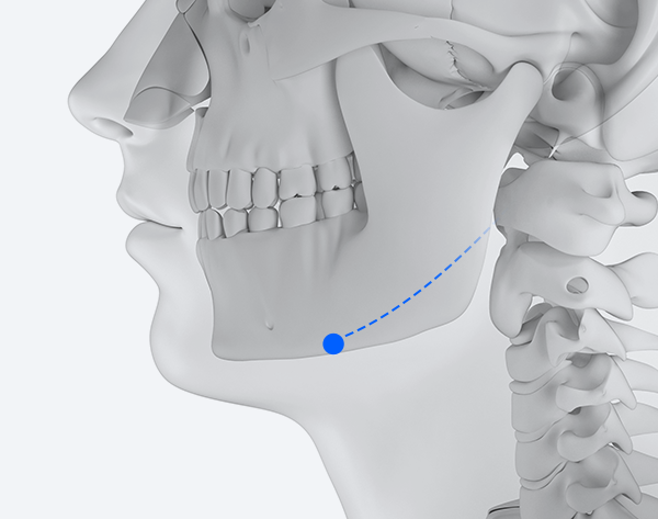 Square jaw reduction only surgery illustration