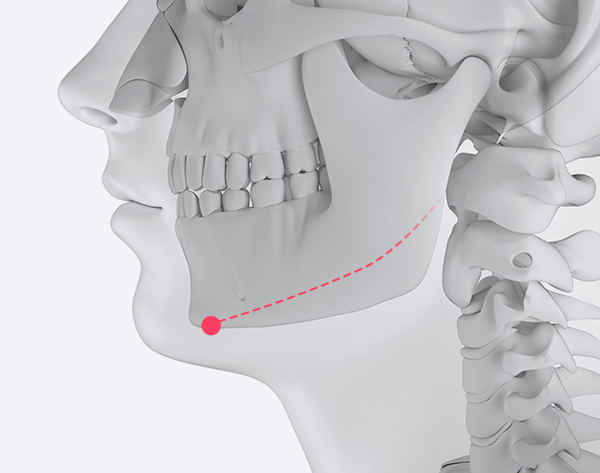 Square jaw reduction + Chin tip reduction combined surgery illustration