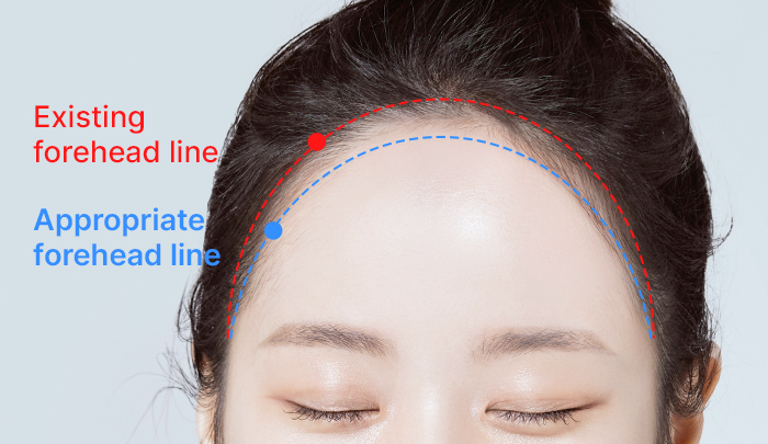 Step 1: Pre-surgery Diagnosis surgery illustration