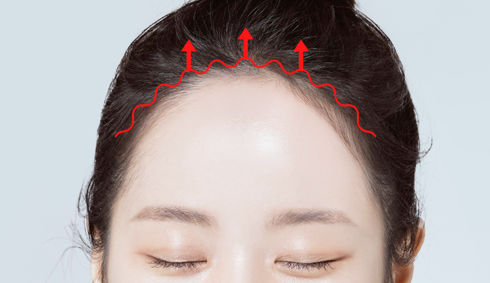 Step 3: Scalp Dissection and Skin Resection surgery illustration