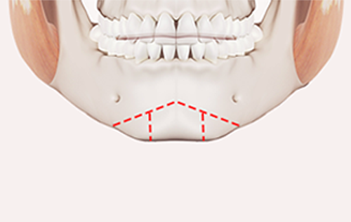 Step 1. Custom design surgery illustration