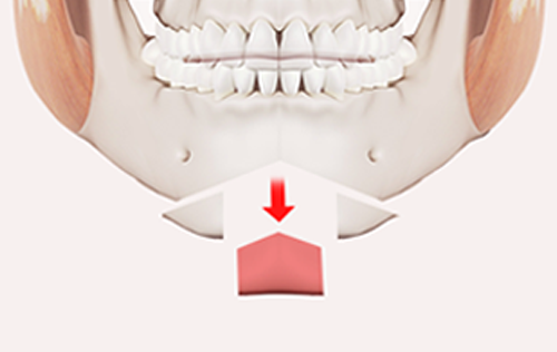 Step 2. Bone Resection/Osteotomy surgery illustration