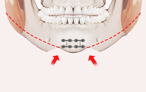 Step 3. Bone Repositioning and Fixation surgery illustration
