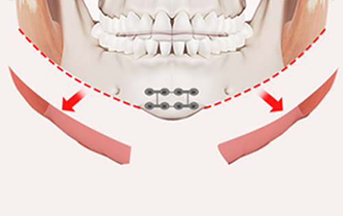 Step 4. Contouring the Jawline surgery illustration