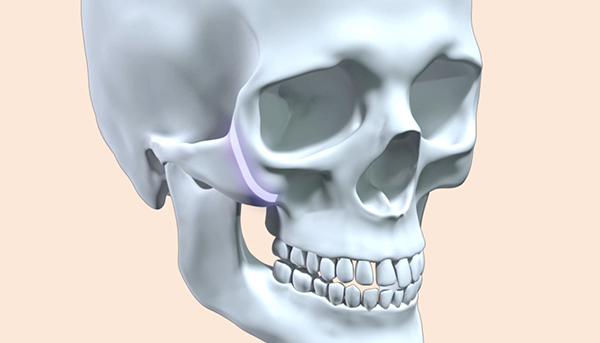 Step 1. Customized Design surgery illustration