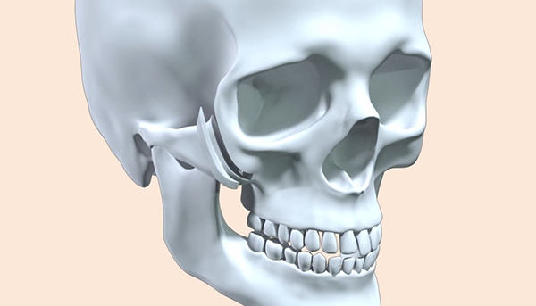 Step 2. L-Osteotomy surgery illustration