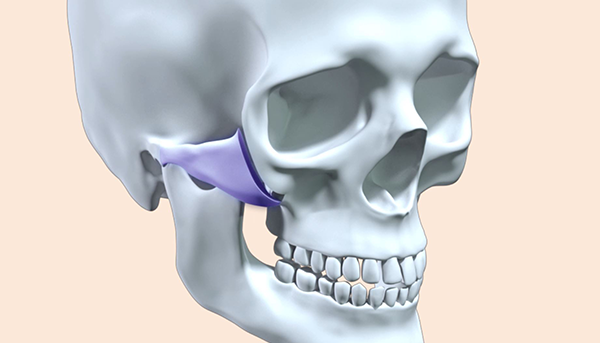 Step 3. Internal Posterior-Superior Rotation surgery illustration
