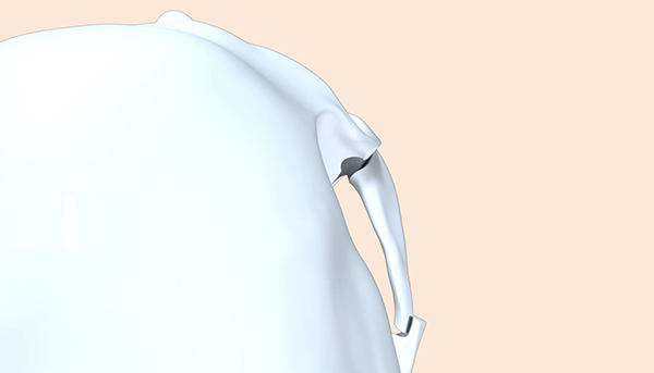 Step 4. Cheekbone Repositioning surgery illustration
