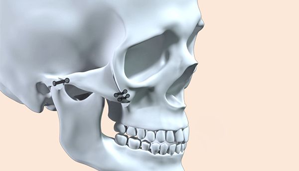 Step 5. Double fixation surgery illustration