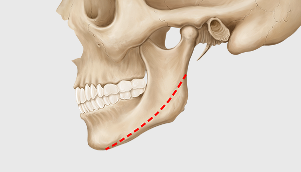 Step 1. Customized Design surgery illustration
