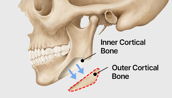 Step 3. Additional Options surgery illustration