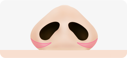 Step 1. surgery illustration