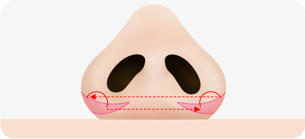 Step 2. surgery illustration