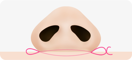Step 1. surgery illustration