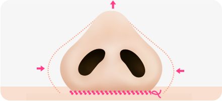 Step 2. surgery illustration