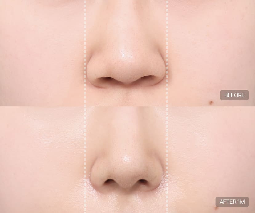 Alar Reduction