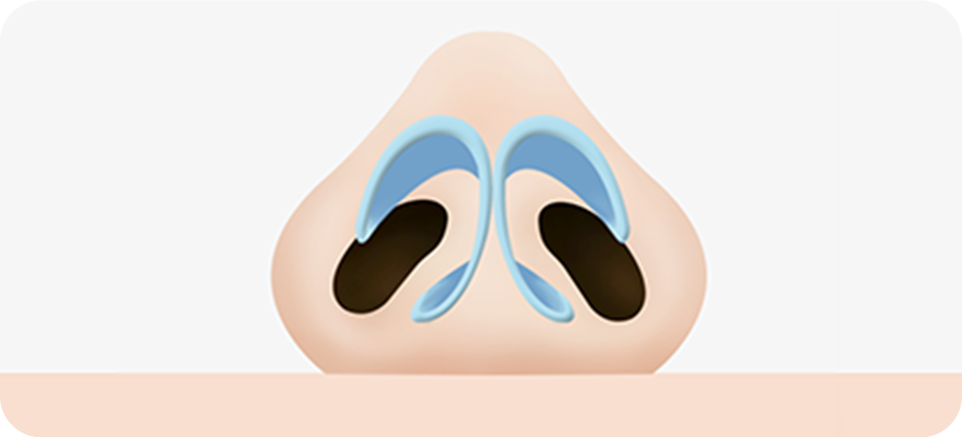 Normal nose surgery illustration