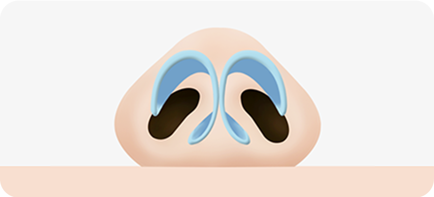 Nose with large alar cartilage and a wide gap between
 the left and right nostrils. surgery illustration