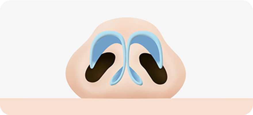 Bulbous nose, with bulbous nasal tip and thick skin tissue surgery illustration